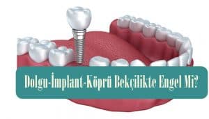 Dolgu – İmplant – Köprü Bekçilikte Engel Mi?