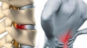 Bel Fıtığı Polisliğe Engel Mi? POMEM – PAEM – PMYO  Bel Fıtığı Engel Mi?