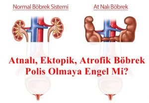 Atnalı, Ektopik, Atrofik Böbrek Polis Olmaya Engel Mi?