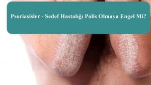 Psoriasisler – Sedef Hastalığı Polis Olmaya Engel Mi?