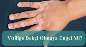 Vitiligo Bekçi Olmaya Engel Mi?