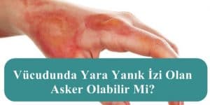 Vücudunda Yara Yanık İzi Olan Asker Olabilir Mi?