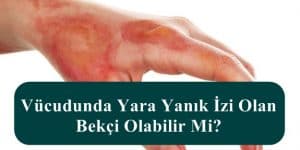 Vücudunda Yara Yanık İzi Olan Bekçi Olabilir Mi?