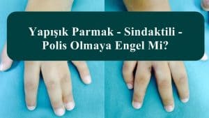 Yapışık Parmak – Sindaktili – Polis Olmaya Engel Mi?