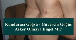 Kunduracı Göğsü – Güvercin Göğüs Asker Olmaya Engel Mi?