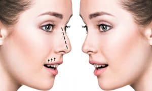 Burun Estetiği – Ameliyatı Asker Olmaya Engel Mi?