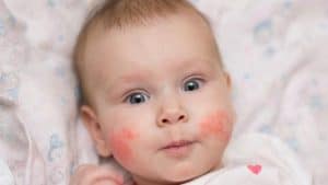 Seboreik Dermatit Bebeklerde Tedavisi Nasıl Yapılmakta?