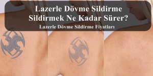 Lazerle Dövme Sildirme – Sildirmek Ne Kadar Sürer?