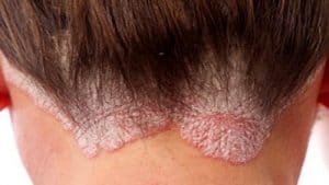 Seboreik Dermatit En Etkili İlaç Hangileridir?