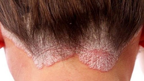 Seboreik Dermatit En Etkili İlaç Hangileridir?