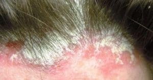 Seboreik Dermatit Kremi Nelerdir?