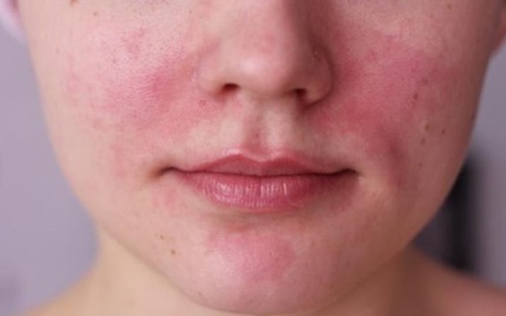 Yüzde Egzama İçin Seboreik Dermatit Kremi Etkili Mi?