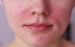 Egzamanın Yaşam Kalitesine Etkileri Nelerdir?