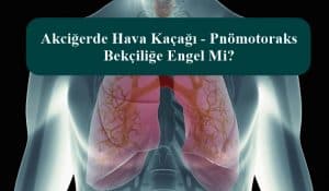 Akciğerde Hava Kaçağı – Pnömotoraks Bekçiliğe Engel Mi?