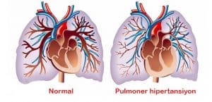 Yeni Doğanlarda Pulmoner Hipertansiyon Nedenleri ve Tedavisi