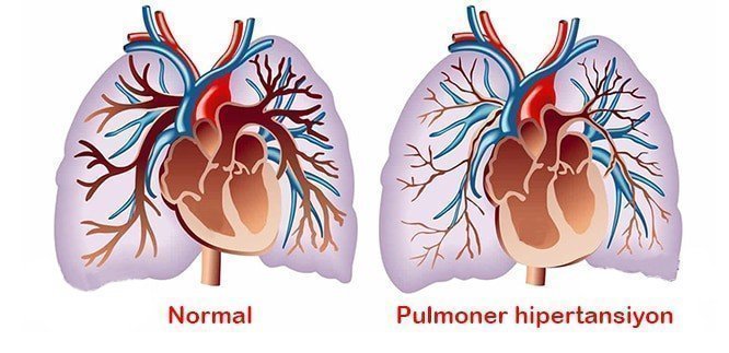 Yeni Doğanlarda Pulmoner Hipertansiyon Nedenleri ve Tedavisi