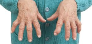 Romatoid Artrit – Ankilozan Spondilit Bekçi Olmaya Engel Mi?