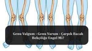 Genu Valgum – Genu Varum – Çarpık Bacak Bekçiliğe Engel Mi?