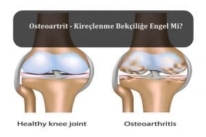 Osteoartrit – Kireçlenme Bekçiliğe Engel Mi? – Bekçi Sağlık Şartları