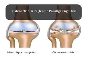 Osteoartrit – Kireçlenme Polisliğe Engel Mi? – Polislik Sağlık Şartları