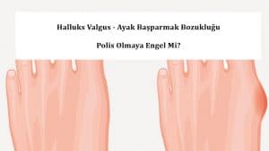 Halluks Valgus – Varus  Ayak Başparmak Bozukluğu Polisliğe Engel mi?