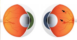 Diyabetik Retinopati: Belirtiler, Tedavi ve Önleme Yöntemleri