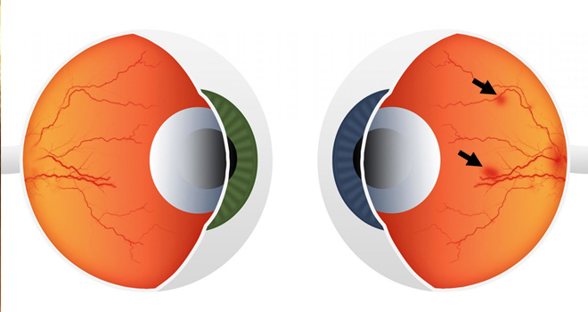 Diyabetik Retinopati: Belirtiler, Tedavi ve Önleme Yöntemleri