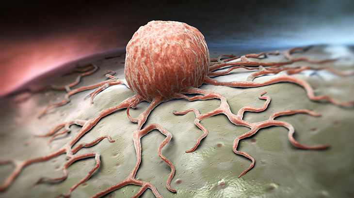 Kanser: Risk Faktörleri, Teşhis ve Tedavi Seçenekleri